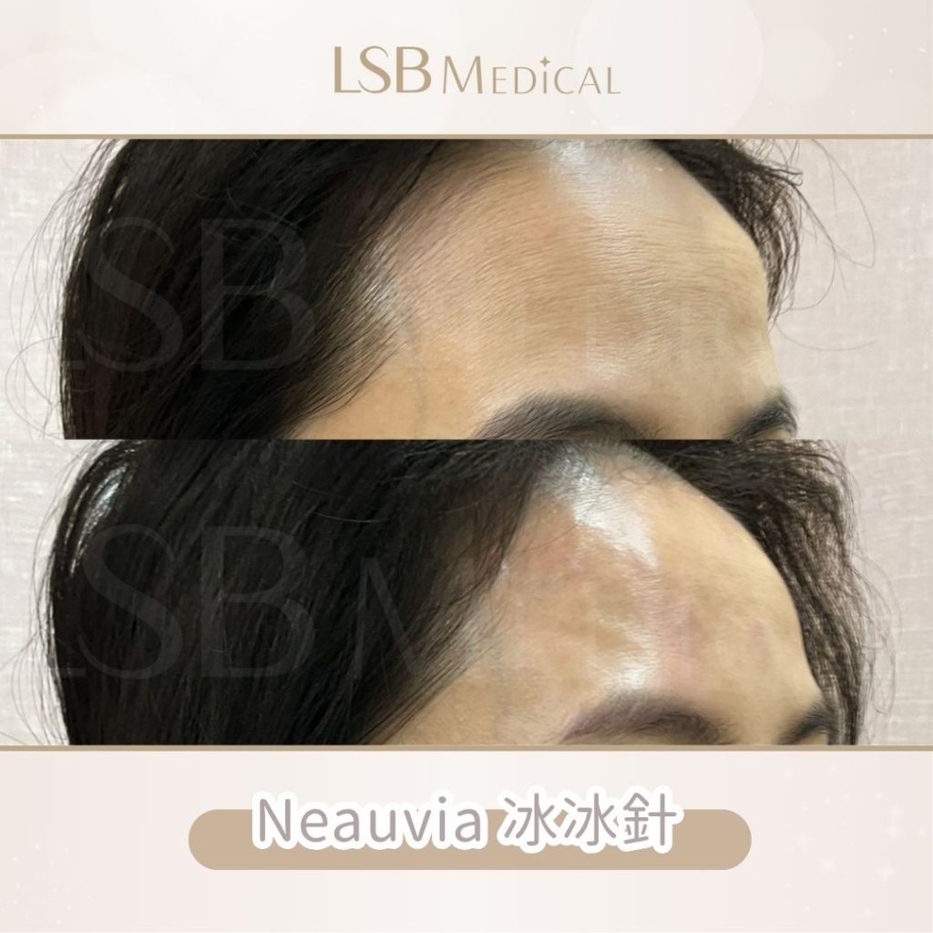 Neauvia冰冰針