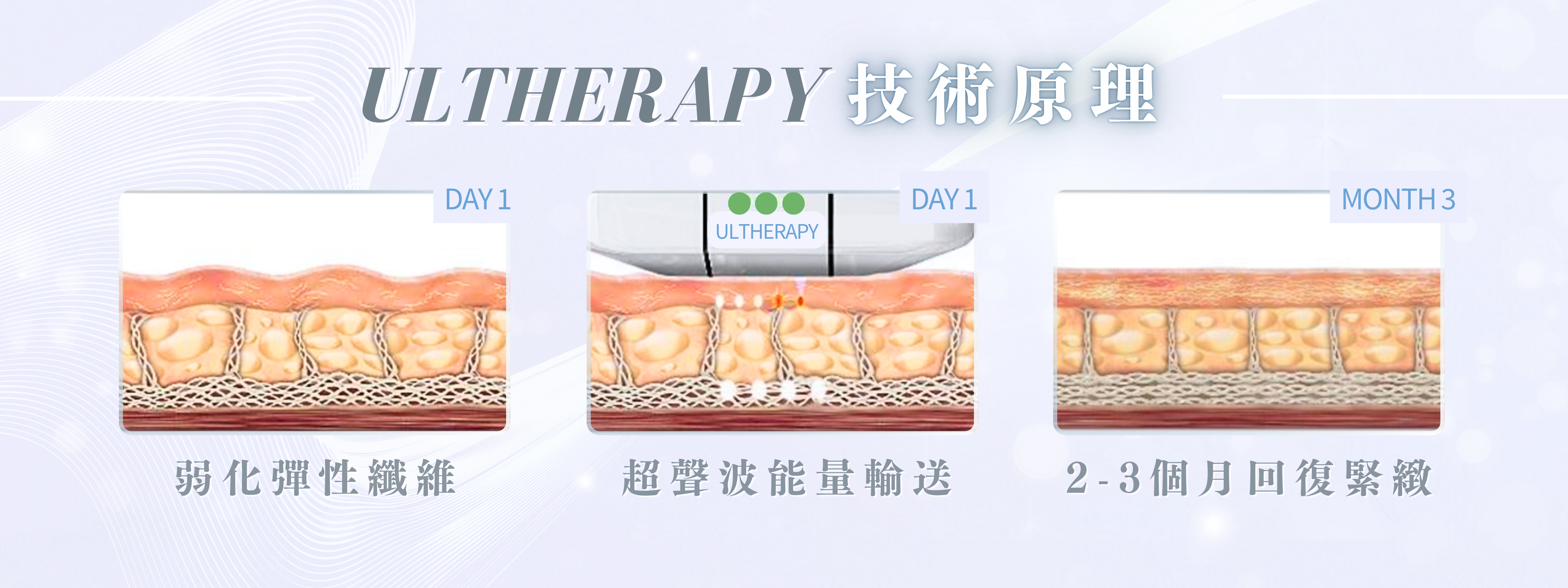 Ultherapy®技術原理