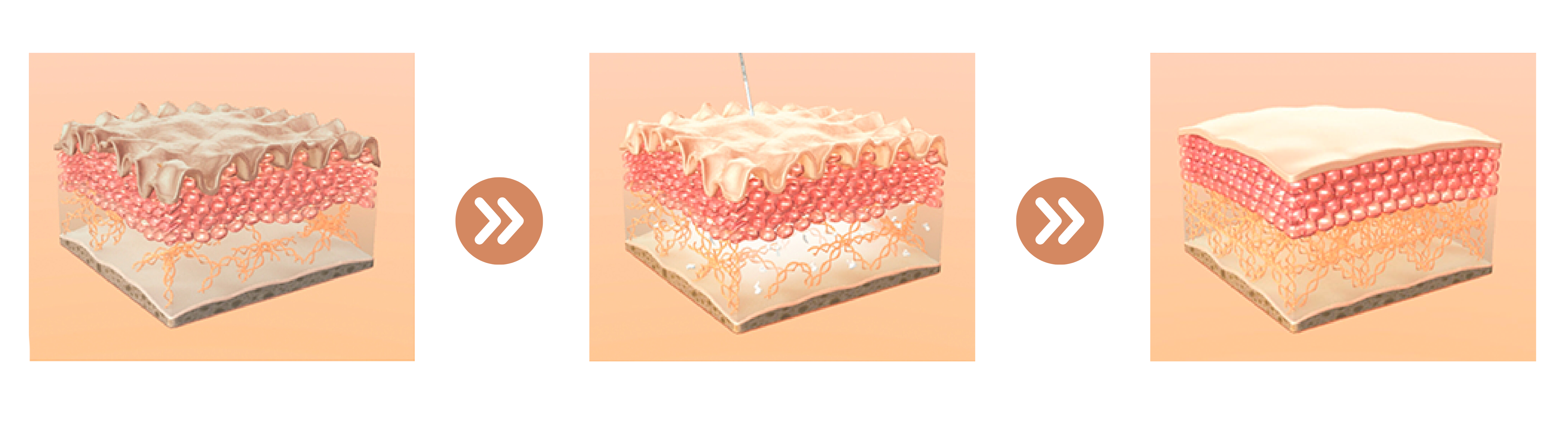 Derma Veil 童顏針