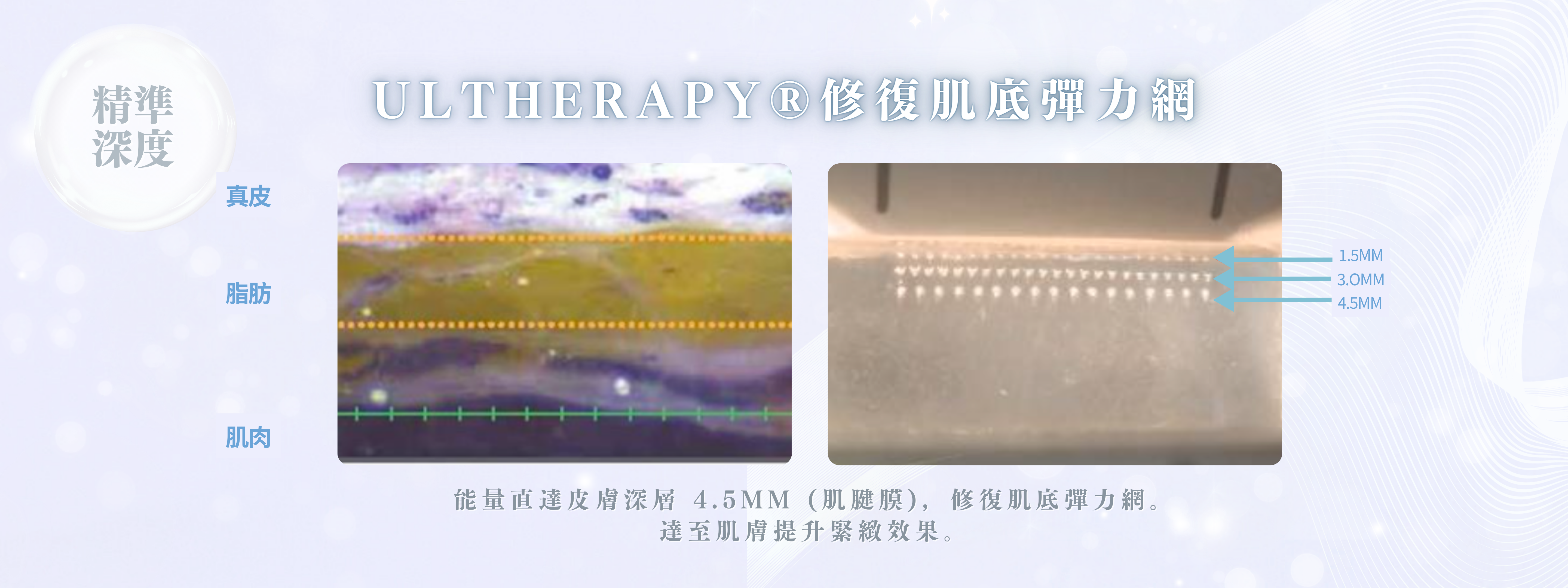 Ultherapy®能量直達皮膚深層4.5mm肌腱膜