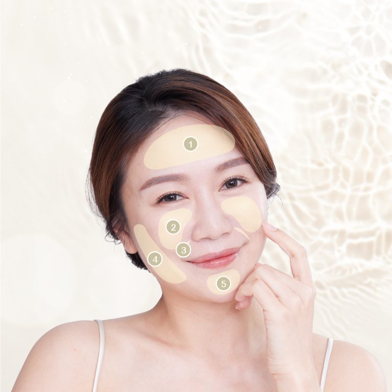 Juvéderm® Volift™適用位置