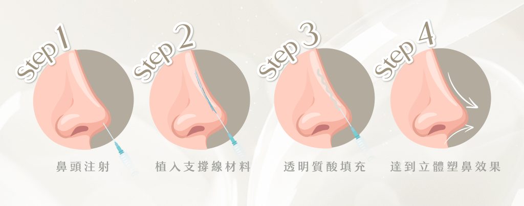 埋線隆鼻