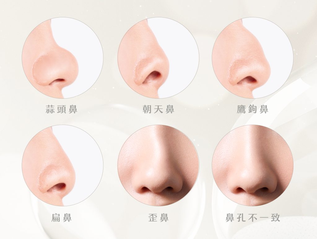 埋線隆鼻適合人士