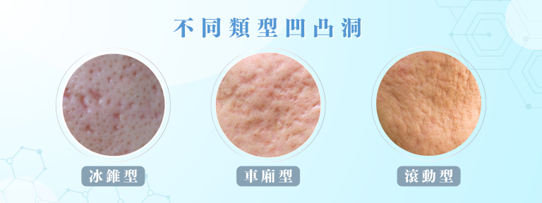 REJURAN麗珠蘭(藍盒)袪痘針