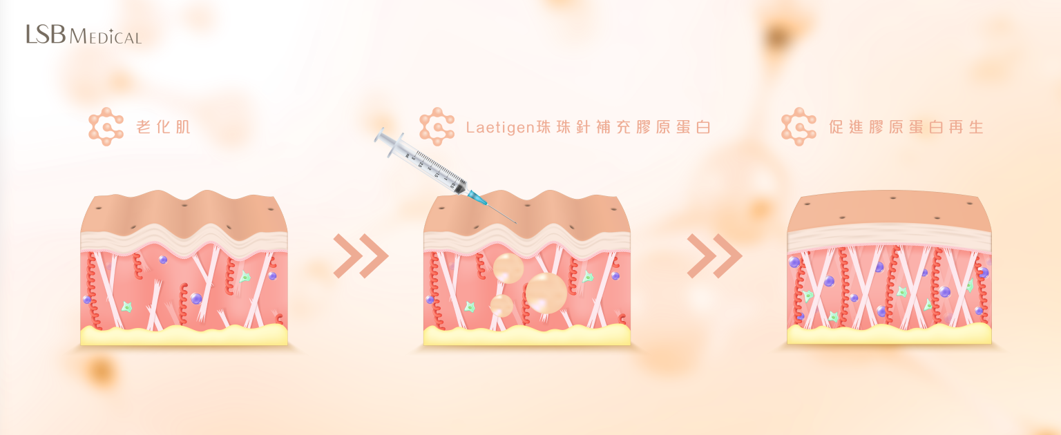 Laetigen珠珠針原理