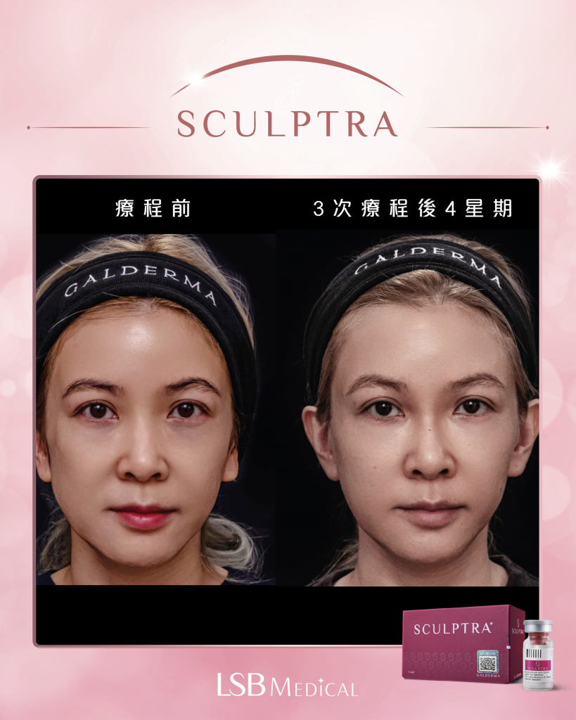 Sculptra®童顏針真實對比