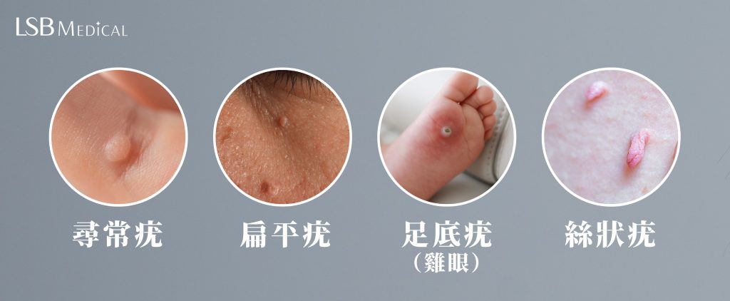 疣的種類