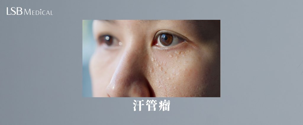 汗管瘤