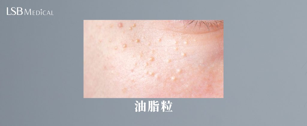 油脂粒