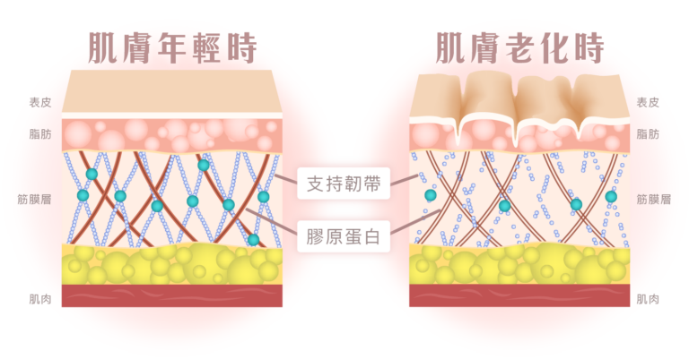 年輕肌膚與鬆弛肌膚支持韌帶結構對比圖，說明10Therma十倍電波拉皮如何改善皮膚下垂鬆弛