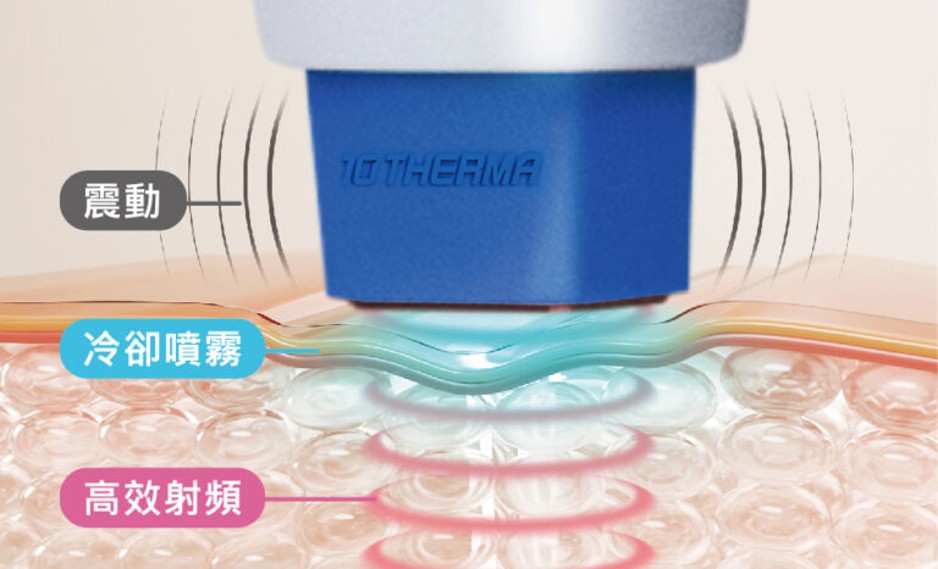 10Therma震動舒緩、STC智能冷卻噴霧及高效單極射頻三重技術運作示意圖
