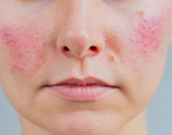 anumi_skin_excelv_rosacea